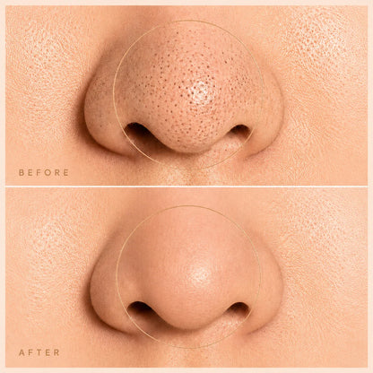 PoreClear™ Facial Extractor Pro - product view 2